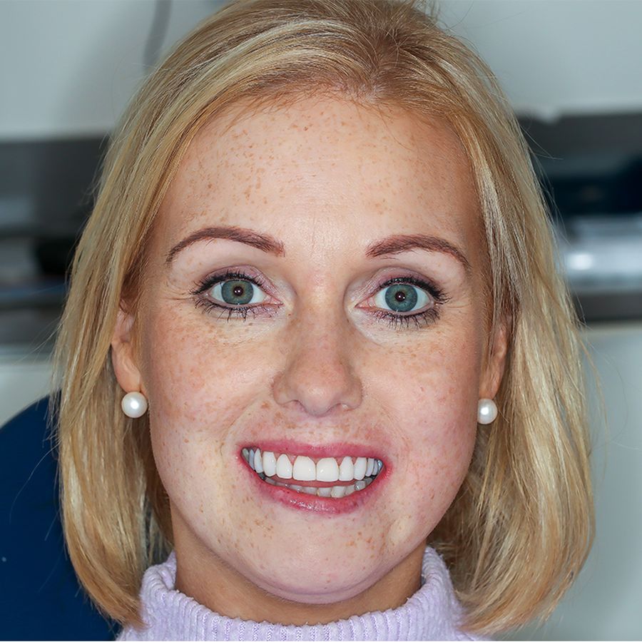 Gingivectomy and surgery after 3Dental